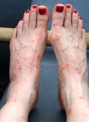 Bug Bites on Ankle - Dermatology - MedHelp